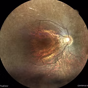 Retinose Pigmentar